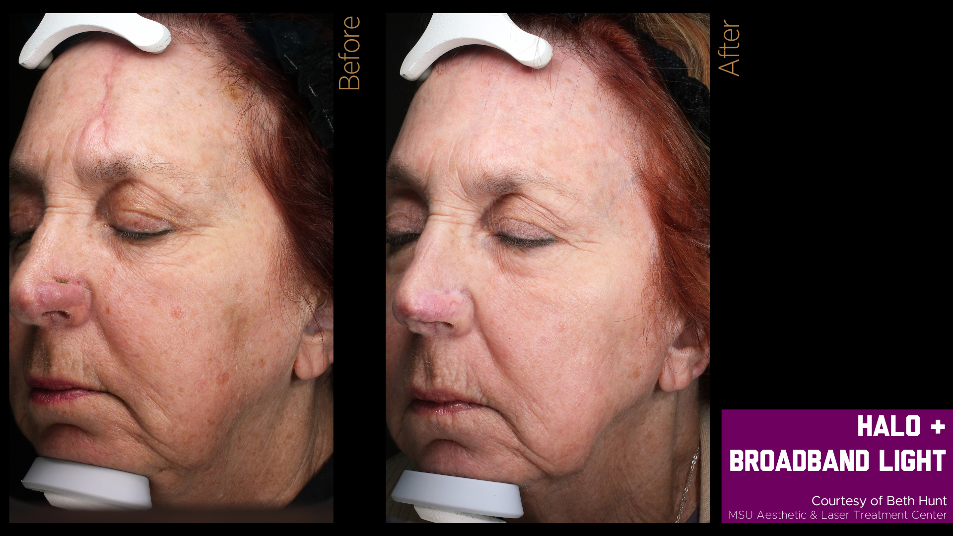 before and after treatment photo