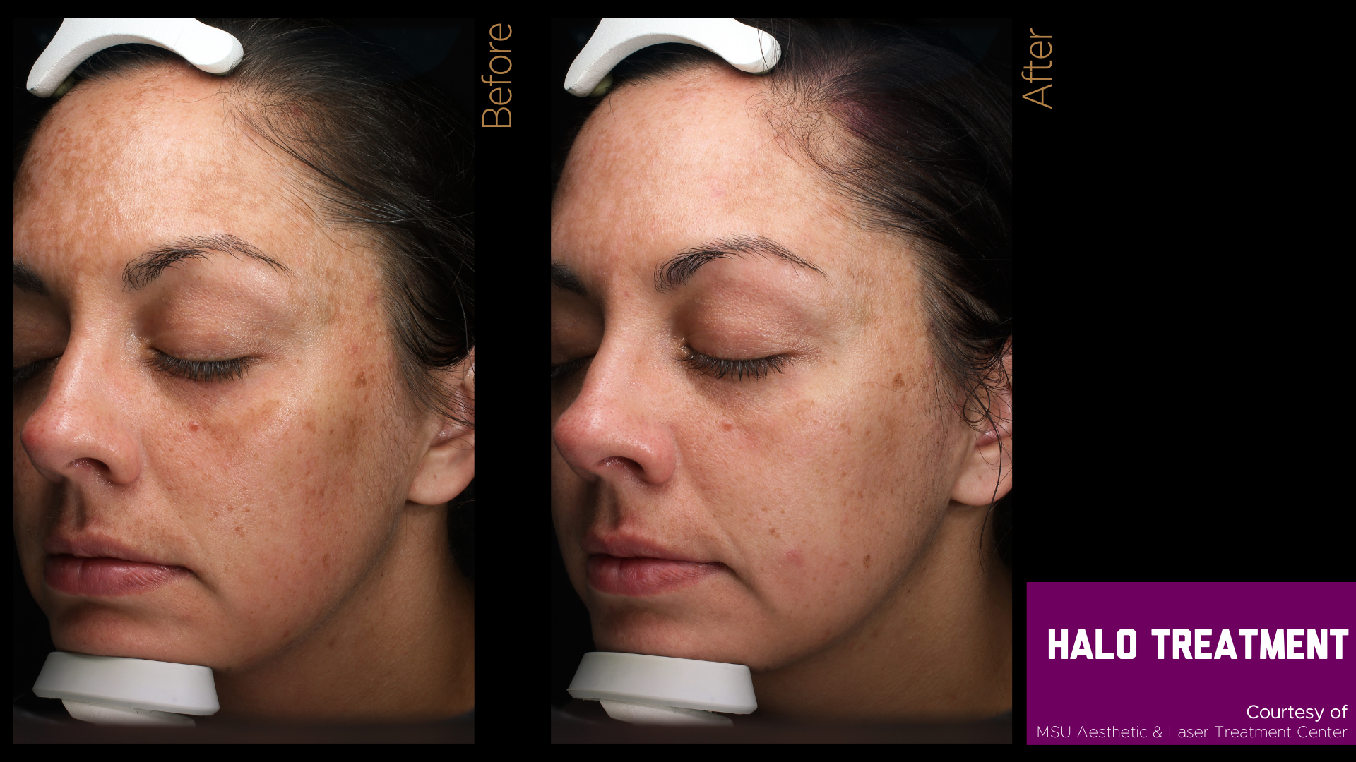 before and after of a halo treatment