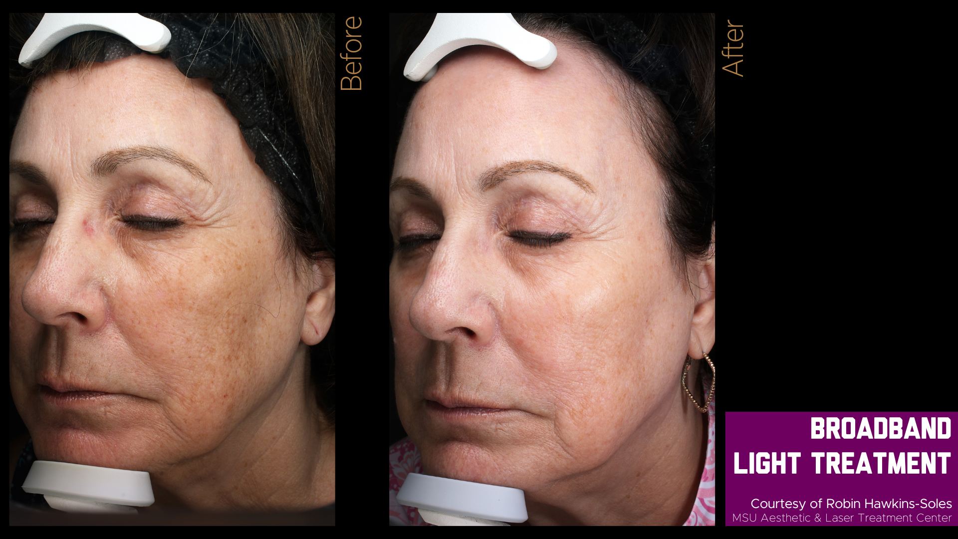 before and after photos of a broadband light treatment