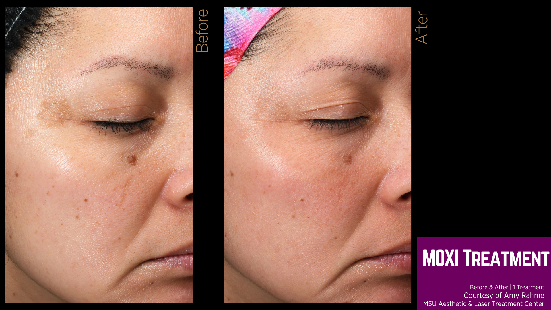 before and after photo of moxi treatment