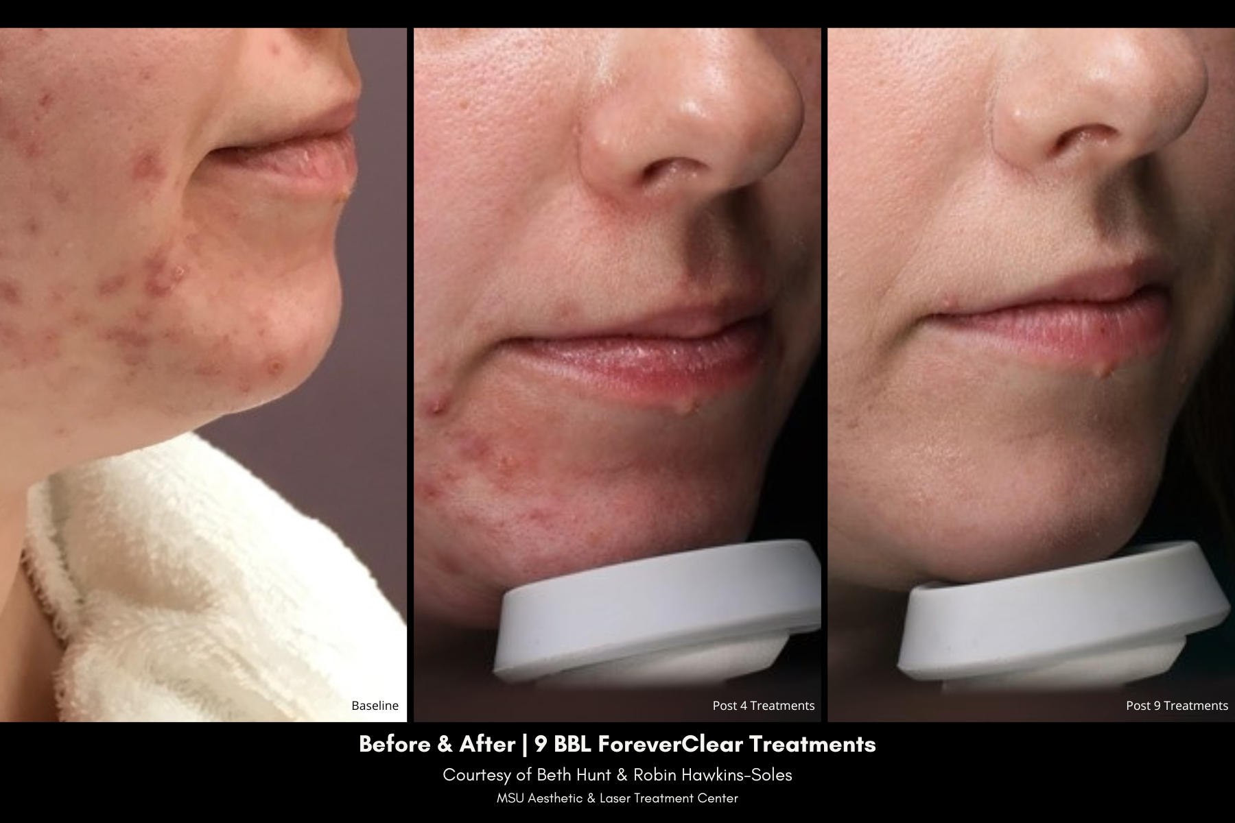 before and after photos of hyperpigmentation treatment